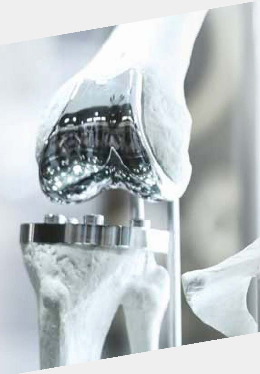 Knee-joint component as a manufacturing illustration.